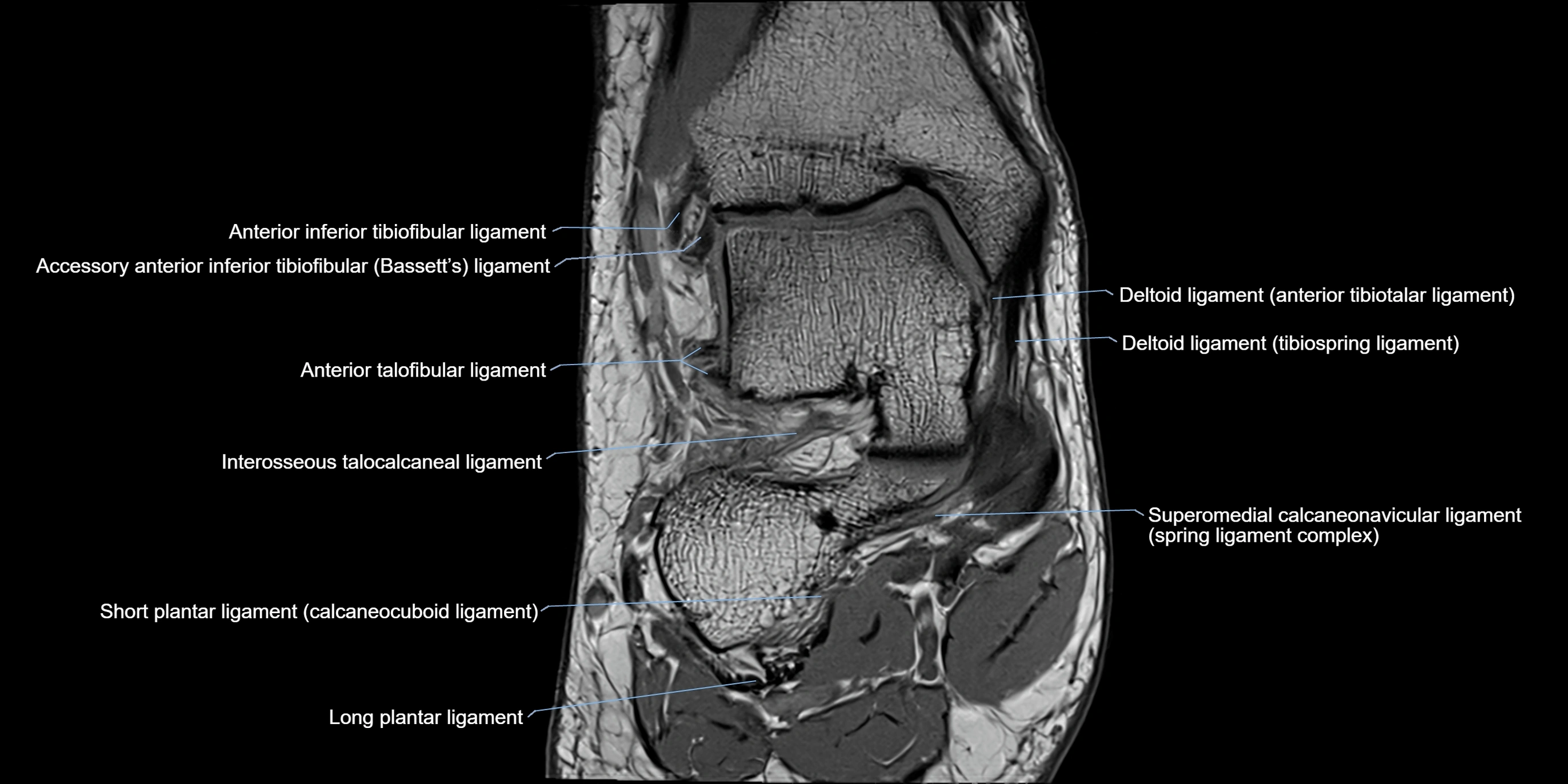 MRI Ankle coronal ligaments cross sectional anatomy 3T  radiology  image-img-00001-00008.webp